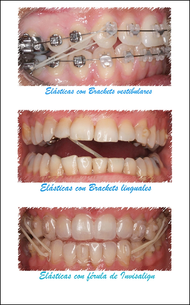 ortodoncia |Ortodoncia Bilbao y Durango Ortodoncia Bilbao | Clínica Castaños